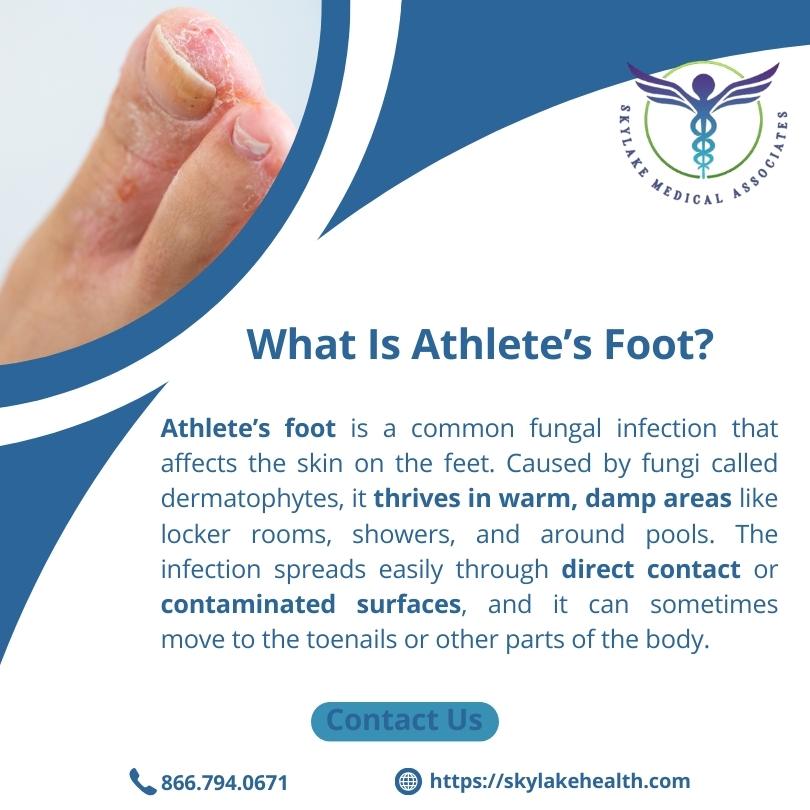 Athlete’s Foot: Identifying Fungal Infections and Treatment Solutions